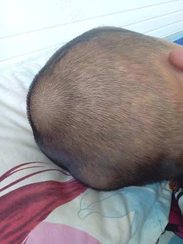 孩子头上生蚤怎么办 孩子头上生蚤怎么办