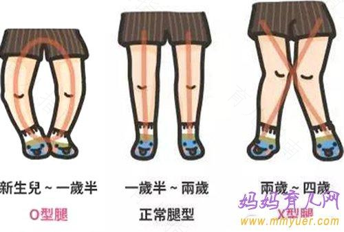 当心孩子O型腿 形成原因先要知