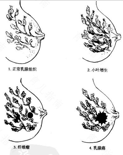 乳腺小叶增生症的特点和治疗要点