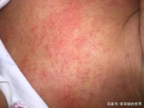 如何防止小宝贝生痱子 如何防止小宝贝生痱子