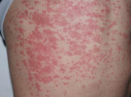 解析湿疹治疗方法