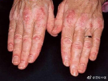 皮肌炎对夫妻生活是否会有影响 皮肌炎对夫妻生活是否会有影响