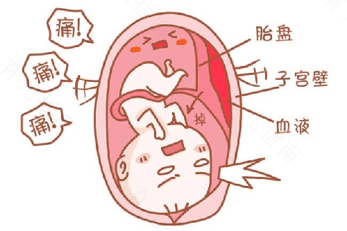 胎盘早剥的症状及治疗