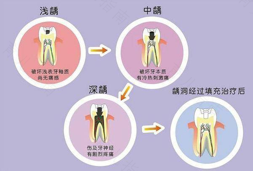小儿龋齿的原因及防治措施
