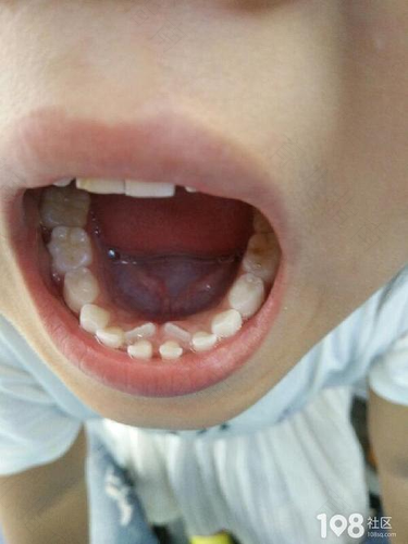 宝宝摔碰后牙齿松动怎么处理 宝宝摔碰后牙齿松动怎么处理