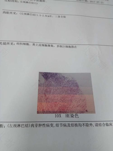 性病性淋巴肉芽肿的三期表现