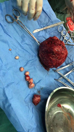 切除子宫后的妇女一般怎么样 切除子宫后的妇女一般怎么样