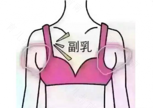 有副乳的危害