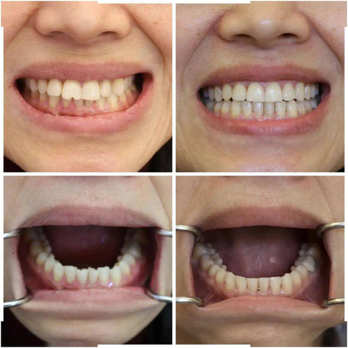 门牙太大怎么办 门牙太大怎么办