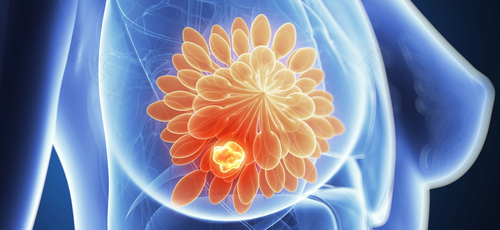 乳腺腺病怎么办 乳腺腺病怎么办
