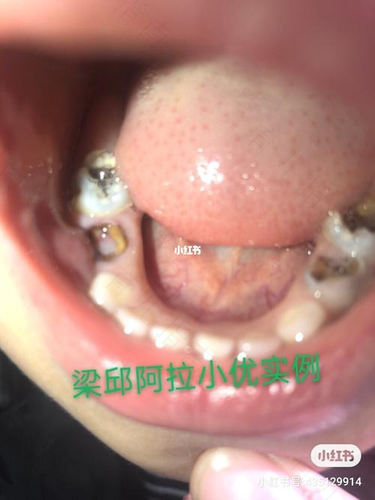 孩子长龋齿怎么办？真的是糖惹的祸吗？