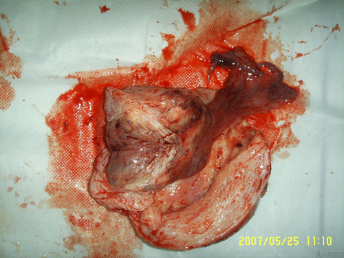 子宫死了是什么原因 子宫死了是什么原因