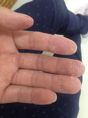 手指爆皮裂口子怎么办 手指爆皮裂口子怎么办