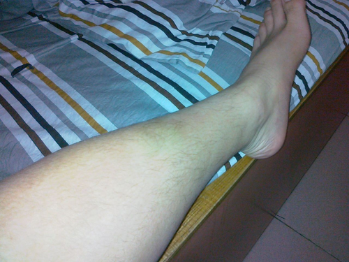 小腿用手按有坑怎么办吃什么药 小腿用手按有坑怎么办吃什么药