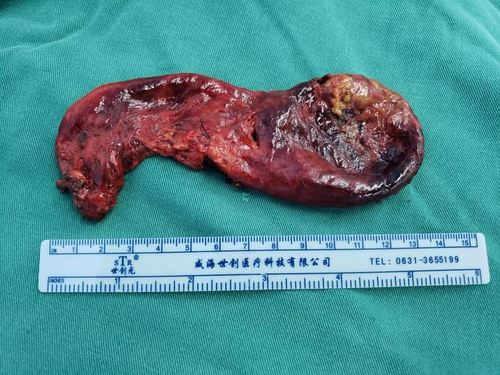 胆囊微创手术后注意事项 胆囊微创手术后注意事项