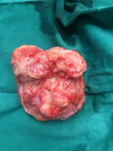 子宫腺肌瘤会引起腹痛腰痛