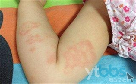 皮疹能吃牛肉吗 皮疹能吃牛肉吗