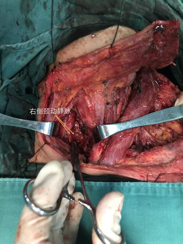 甲状腺切除后能活多久怀孕 甲状腺切除后能活多久怀孕