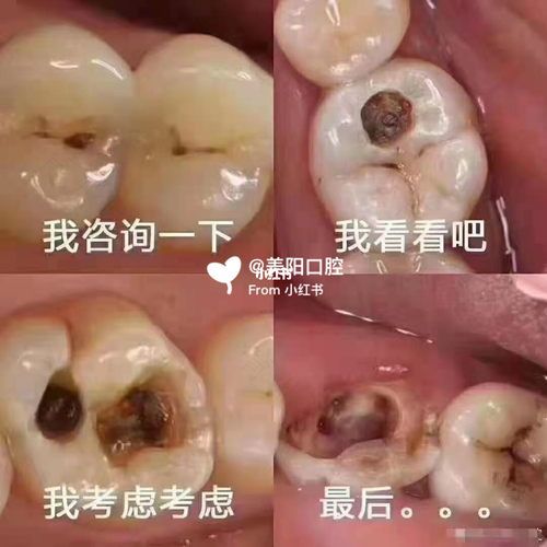 龋齿很严重怎么办 龋齿很严重怎么办