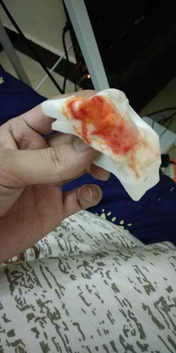 感冒流鼻涕带血怎么办 感冒流鼻涕带血怎么办