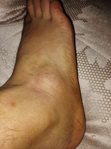 脚筋扭伤怎么办恢复快 脚筋扭伤怎么办恢复快