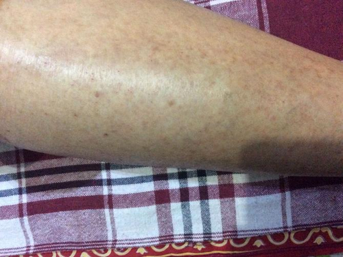 老人手痒怎么回事