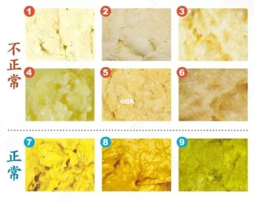 宝宝发生黄疸时的一些情况 宝宝发生黄疸时的一些情况