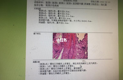 宫颈活检多少天有结果 宫颈活检多少天有结果