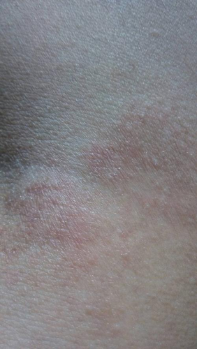 肚皮上起了癣怎么办 肚皮上起了癣怎么办