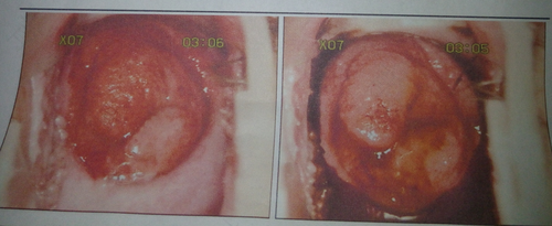 宫颈纳氏囊肿用手能摸出来吗