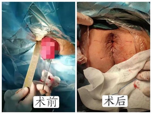 轻度脱肛怎么治疗? 轻度脱肛怎么治疗?