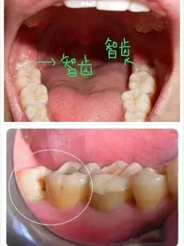 开刀拔智齿拆线疼吗 开刀拔智齿拆线疼吗