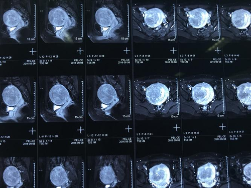 瘢痕子宫胎盘前壁一定要做核磁共振吗? 瘢痕子宫胎盘前壁一定要做核磁共振吗?