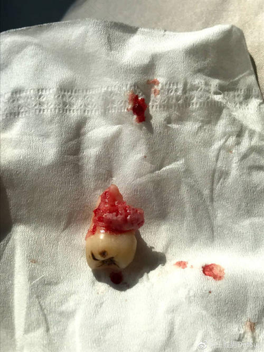 拔完牙牙洞很臭 拔完牙牙洞很臭