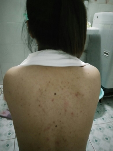 后背起粉刺疙瘩怎么回事