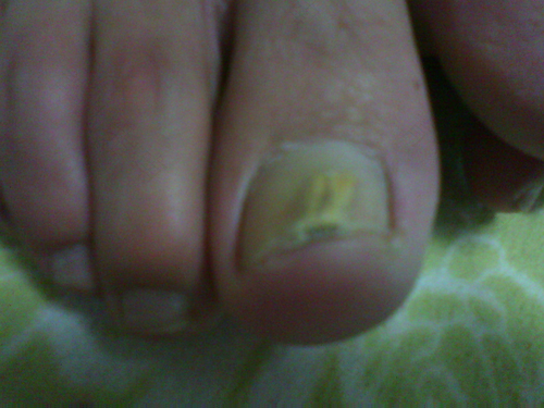 脚大指甲变厚变黄是怎么回事 脚大指甲变厚变黄是怎么回事