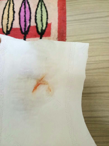 鼻涕带血是上火了吗 鼻涕带血是上火了吗