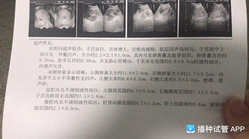 右侧卵巢增大怎么回事 右侧卵巢增大怎么回事