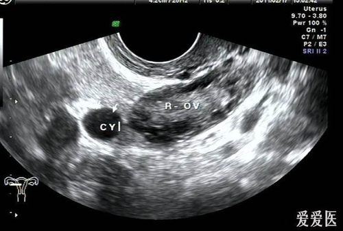 什么是输卵管系膜囊肿可能 什么是输卵管系膜囊肿可能