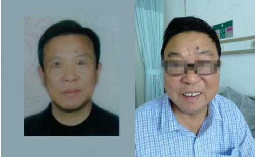 满月脸怎么恢复正常 满月脸怎么恢复正常