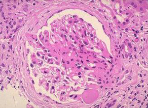 慢性肾炎是怎么得的,如何治疗 慢性肾炎是怎么得的,如何治疗