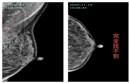 乳腺囊壁钙化是什么意思 乳腺囊壁钙化是什么意思