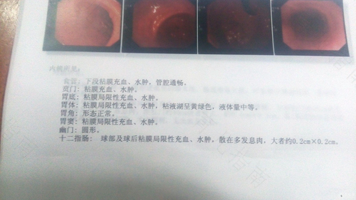 小肠结肠炎的症状表现