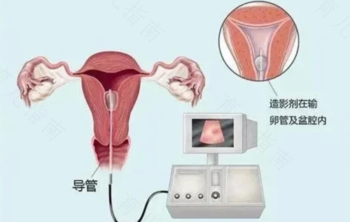 宫颈糜烂会影响输卵管堵塞吗 宫颈糜烂会影响输卵管堵塞吗