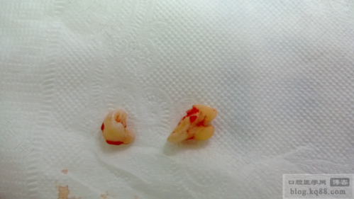 拔牙打麻药多久才消失 拔牙打麻药多久才消失