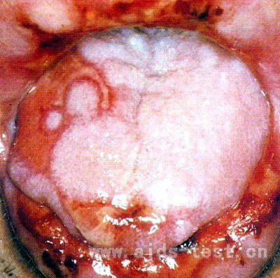 白色念珠菌要治疗多久