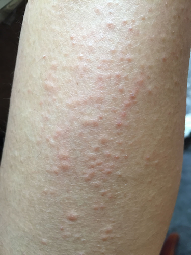 脸过敏两个月了还没好怎么办 脸过敏两个月了还没好怎么办