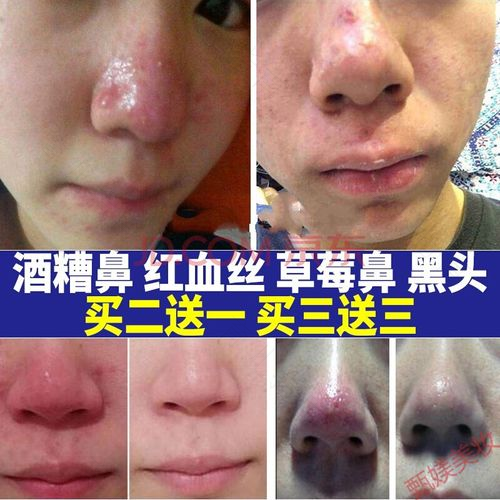 小孩鼻子有血丝是怎么回事