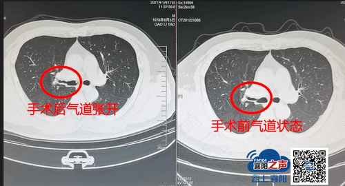 呼吸道狭窄手术属于大手术吗 呼吸道狭窄手术属于大手术吗