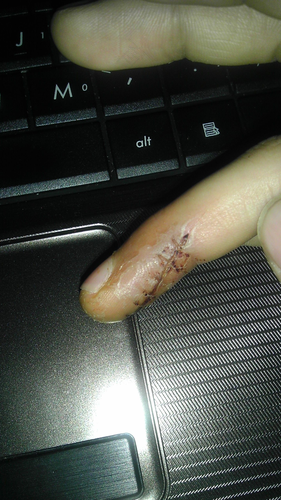 伤口拆线后红肿怎么办 伤口拆线后红肿怎么办